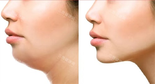 双下巴吸脂