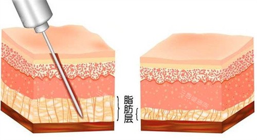 武汉亚韩整形付国友怎么样?吸脂塑形均匀,大腿环吸术后流畅,穿裙超显腿细！