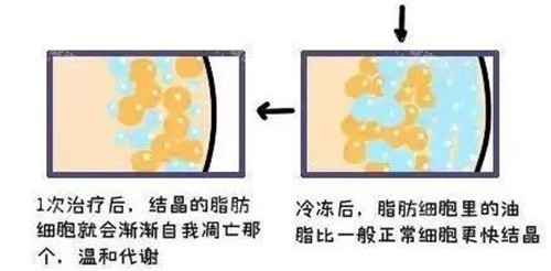长沙亚韩整形付国友怎么样?腰腹吸脂平整度高,皮肤紧致不松弛,辣妈都选他面诊！