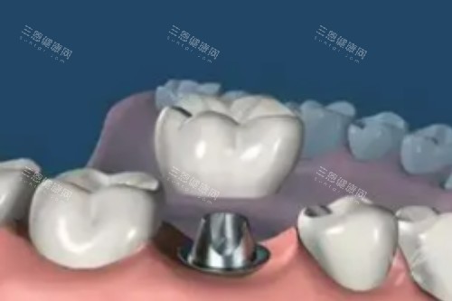 亲身体验！河池伊皓口腔种植牙结果惊人，解决多年缺牙困扰！