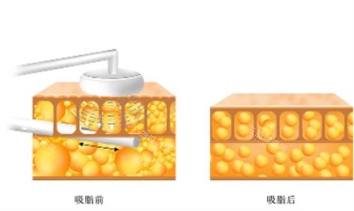 深圳全身吸脂费用大概多少？2026新攻略：费用清单+口碑医院真实测评！