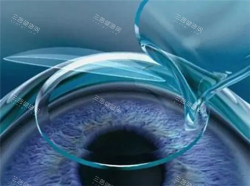 艾维眼科医院怎么预约？微信预约/官网预约/电话预约等流程近视眼手术