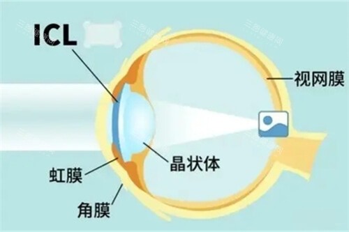 郑州二院晶体植入费用价格？ICL、三焦点等晶体手术价格一览！