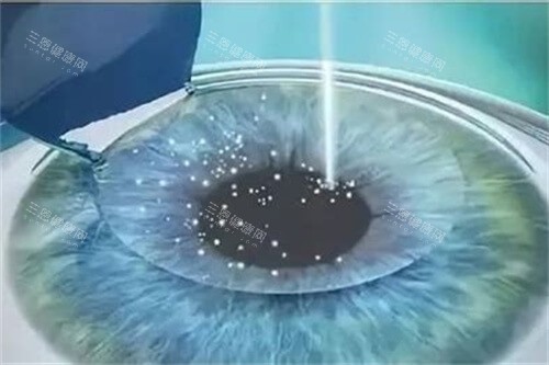 赵阳4L疗法治近视多少钱？2.5万/年能缩眼轴？低于此价需警惕假货