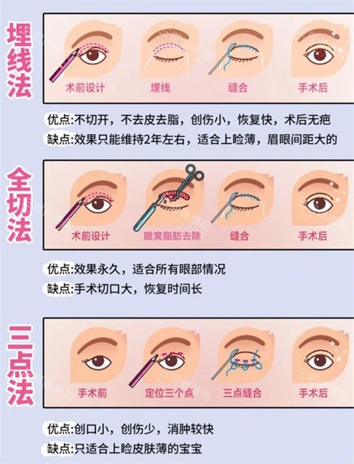 上海曾翾医生怎么预约挂号？双眼皮修复挂德媛门诊，微信/电话/现场多渠道可选