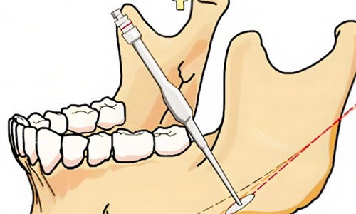 下颌角手术过程 下颌角手术过程