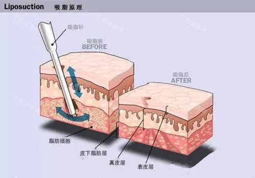 水动力吸脂手术原理动画图 水动力吸脂手术原理动画图