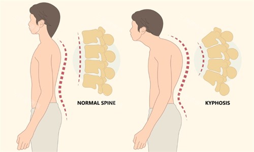 富贵包让人看起来驼背 富贵包让人看起来驼背