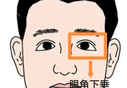 眼角下垂漫画示意图