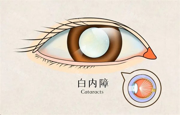 厦门医学院附属第二医院眼科价格表查看，近视手术7000起/角膜塑形镜4283元起/斜视5691元起！