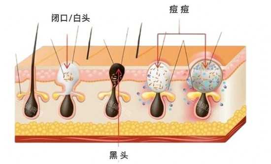 闭口黑头白头照片