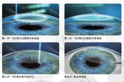厦门市第一医院眼科收费标准公布，近视手术9800起/白内障5000起/青光眼3000起！