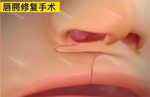 唇裂修复手术即刻形状