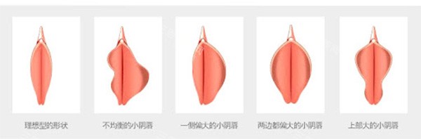 激光紧缩vs手术紧缩怎么选？看完20位姐妹真实体验你就懂了！