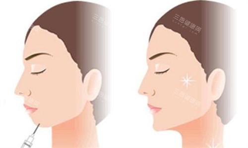 隆下巴
