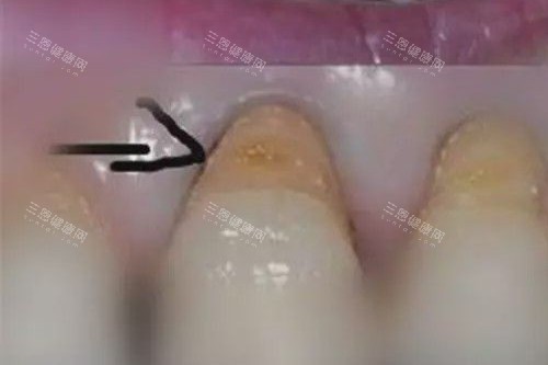 牙齿楔状缺损照片
