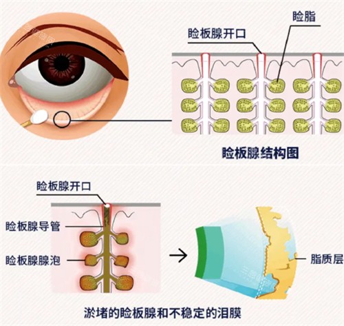 关于爱尔眼科睑板腺疏通1000一次正常吗?一起来看看它的价格和性价比吧