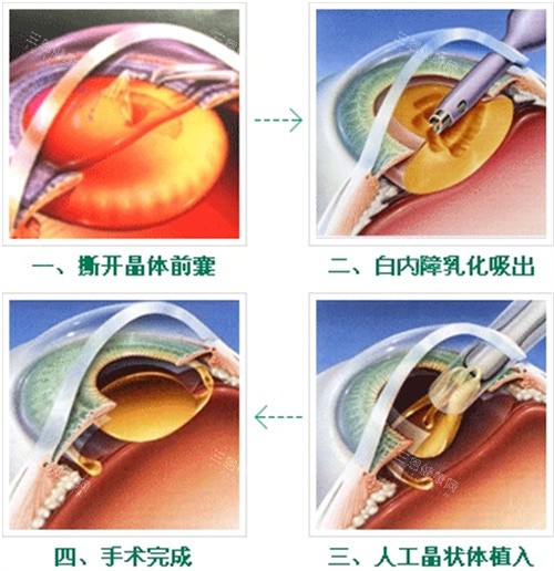 漳州市医院眼科收费标准公布，近视矫正11135元起/白内障4500起/青光眼3482元起！