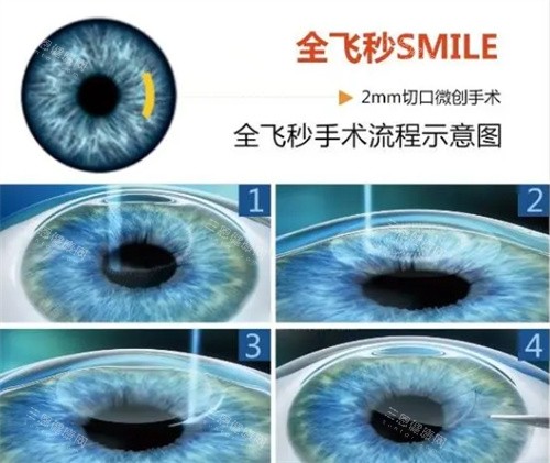 西京医院全飞秒手术价格表：2025年全新价目，参考价1.8万元起！