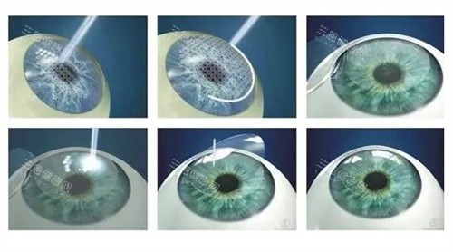 梧州爱尔眼科医院怎么样？医院规模、特色科室及近视矫正、眼底病治疗实例