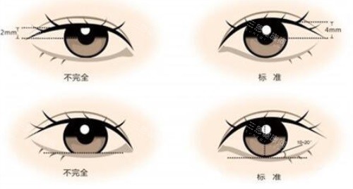 洛阳孔繁荣割双眼皮怎么样？医生手术风格、实例结果、术后反馈及收费标准