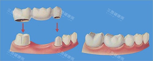 假牙牙冠示意图