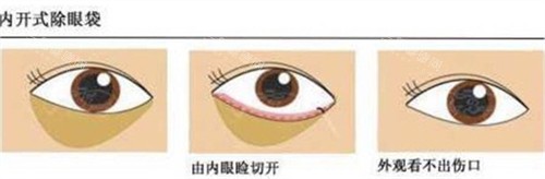 2025正规医院祛眼袋价格曝光！内切 3000-8000 / 外切 5000-1.2 万，术式差异 + 影响因素解析