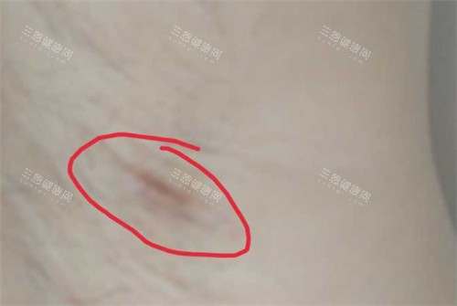 腋臭区域图
