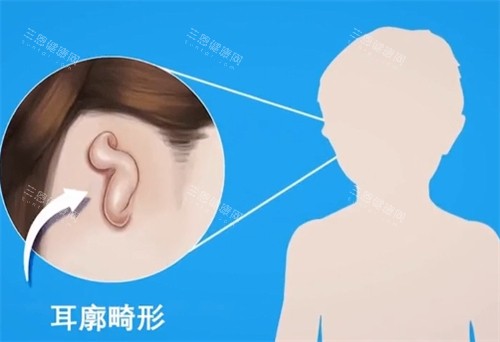 耳廓畸形