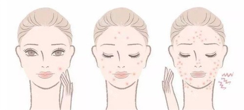 敏感肌症状 敏感肌症状