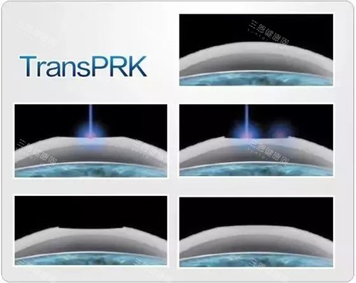 TPRK近视手术示意图