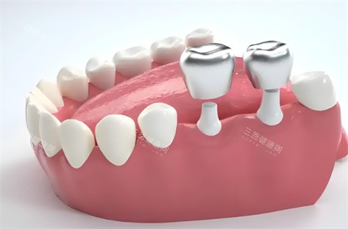 兰州种牙价格大公开：韩国登腾2980元起、美国皓圣5580元起、瑞士ITI6980元起！