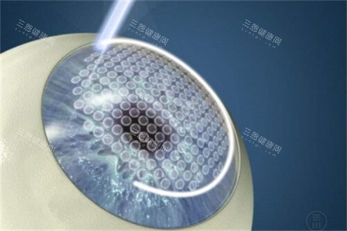 南昌大学附属医院做近视手术好吗？本省人公认的靠谱，医生操作细致！