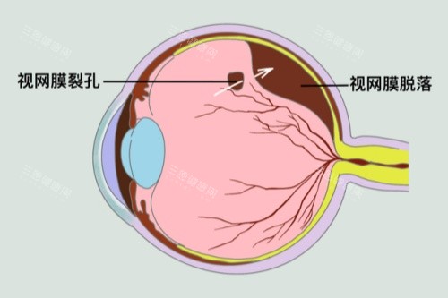 2025人工视网膜植入术价格表出炉：国产3万起vs进口12万起，手术费另加5千-1.5万起，明细看这！