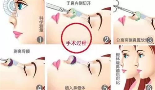 李信峰和李保锴做鼻子谁技术更好？李信峰擅长复杂鼻修复，李保锴做初鼻自然不夸张，附真实病例