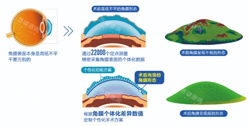 普瑞好还是爱尔眼科好？两家医院在技术水平上算是1:1的能力！