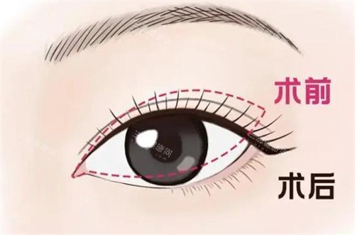 谭敏峰双眼皮修复强在哪？广州高尚坐诊，资历足技术熟审美还独特