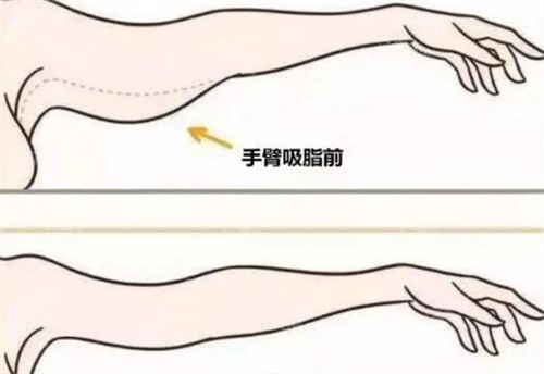 深圳万晓楠手臂吸脂