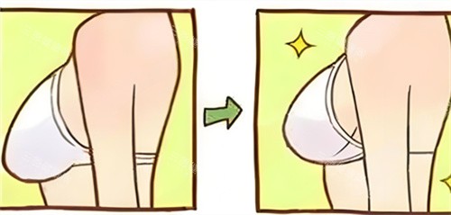 深圳万晓楠胸部缩小术前后对比动画图