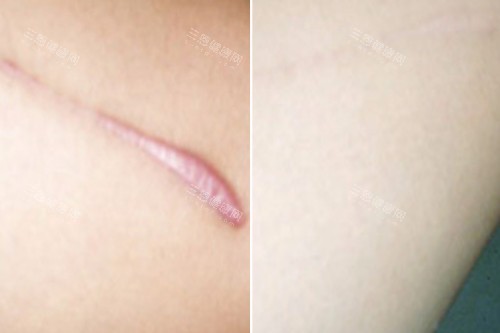 重庆杨东运增生疤痕修复对比图