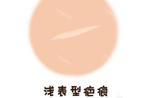 重庆杨东运浅表型疤痕修复改善