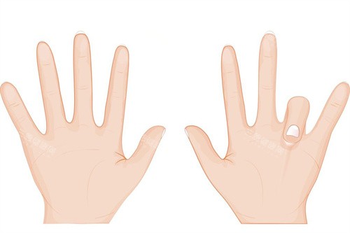 断指再造术收费合理吗？1-2万/指含术后护理，显微技术提升成活率！