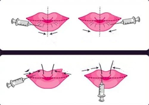 玻尿酸丰唇前后对比图 玻尿酸丰唇前后对比图