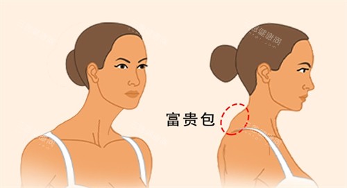 石家庄富贵包治疗哪个医院好？黄学峰富贵包手术是真的好，操作娴熟成效显著