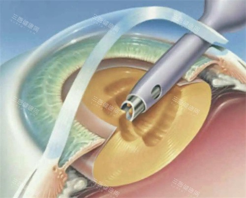镇江白内障免费医疗如何申请？2024年新政策与申请条件全指南！