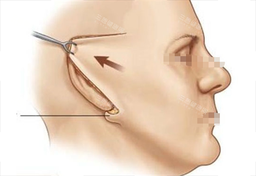 拉皮手术切口展示 拉皮手术切口展示