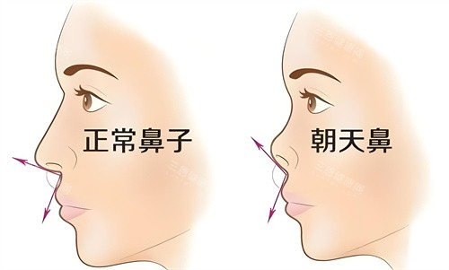 正常鼻子与朝天鼻对比动画图