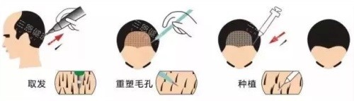 植发过程图
