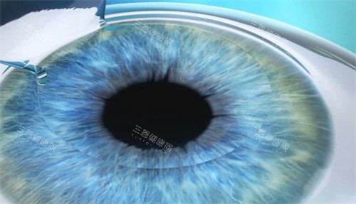 开封市近视眼手术收费价格一览表！激光1万起，ICL 2.8万起，明码标价！