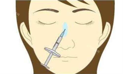 菲林普利隆鼻能维持多久?带你摸清这门“持久战”的门道